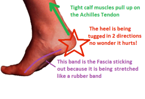 tight calves = sore fascia